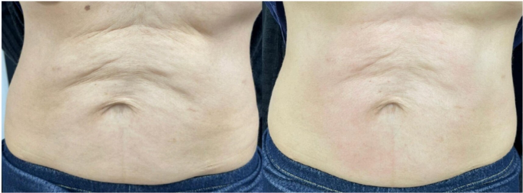 Before and after body contouring on abdomen