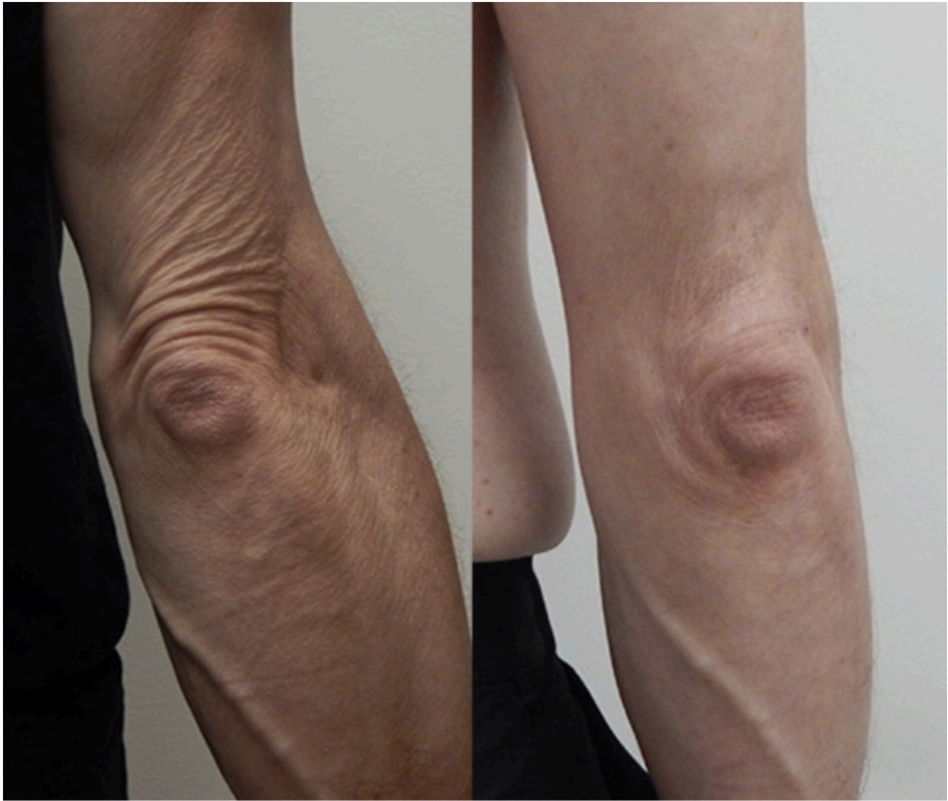 Before and after body skin tightening on knee area