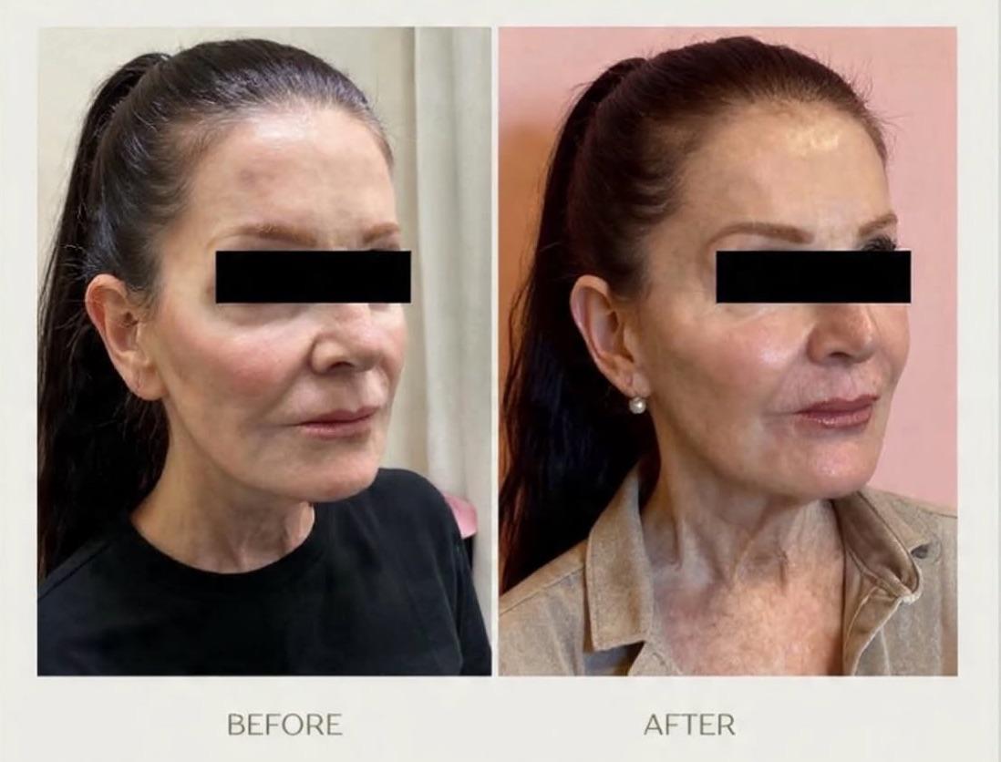 Before and after facial contouring with injectables
