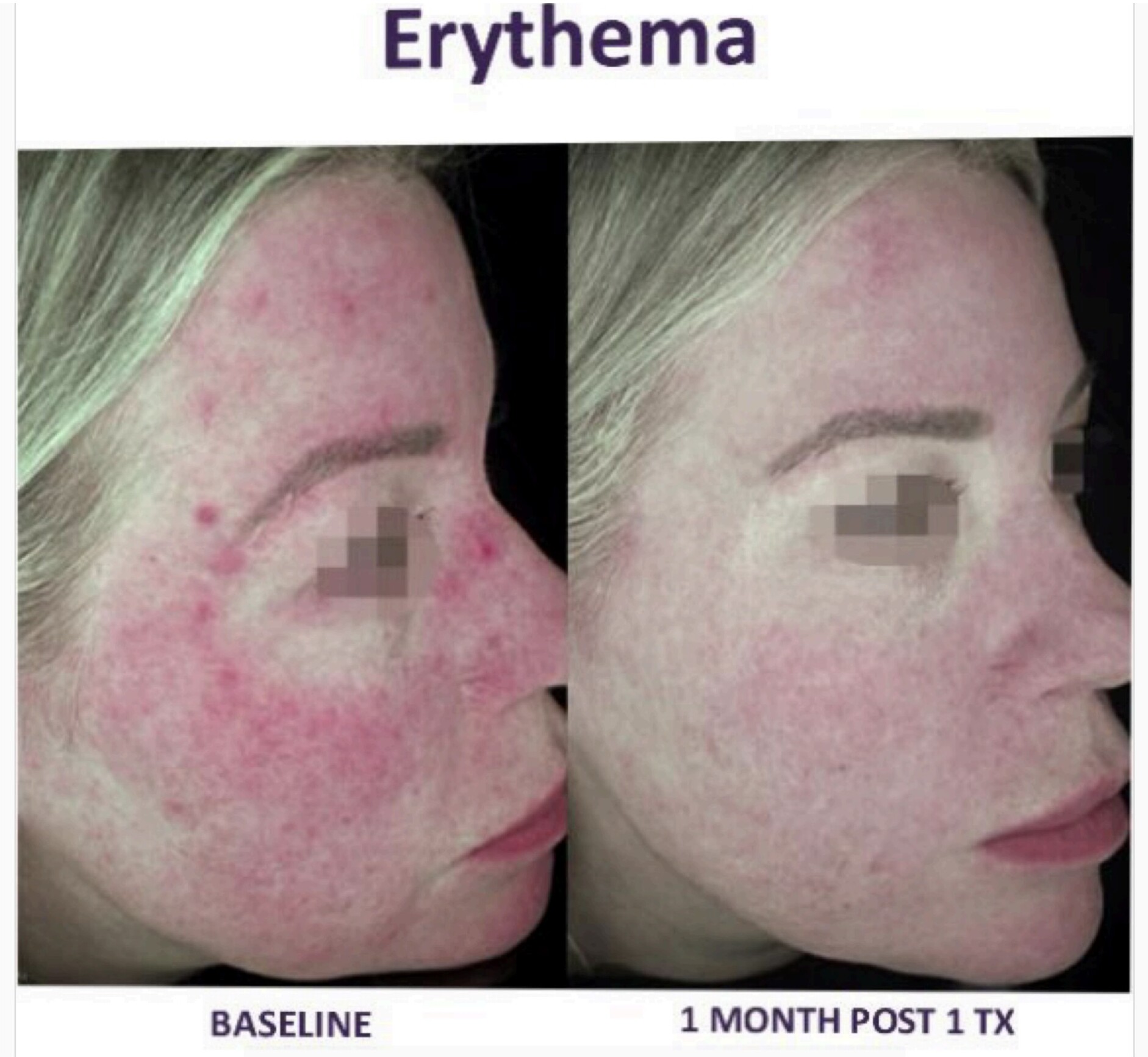 Before and after laser treatment for erythema
