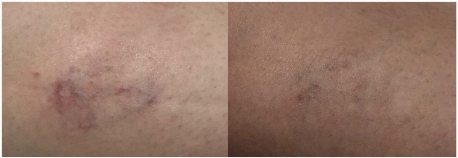 Before and after spider vein laser treatment