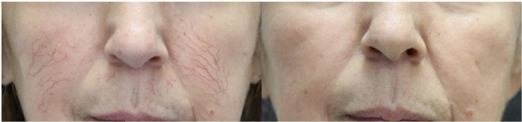 Before and after laser treatment for telangiectasia