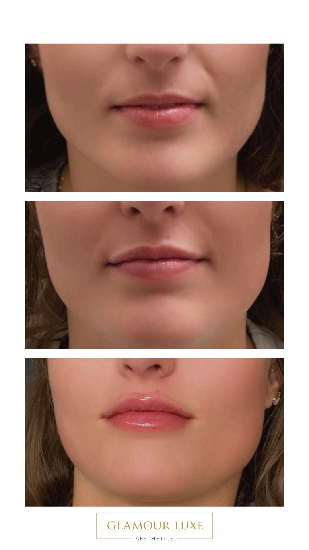 Lip enhancement progression showing natural volume increase