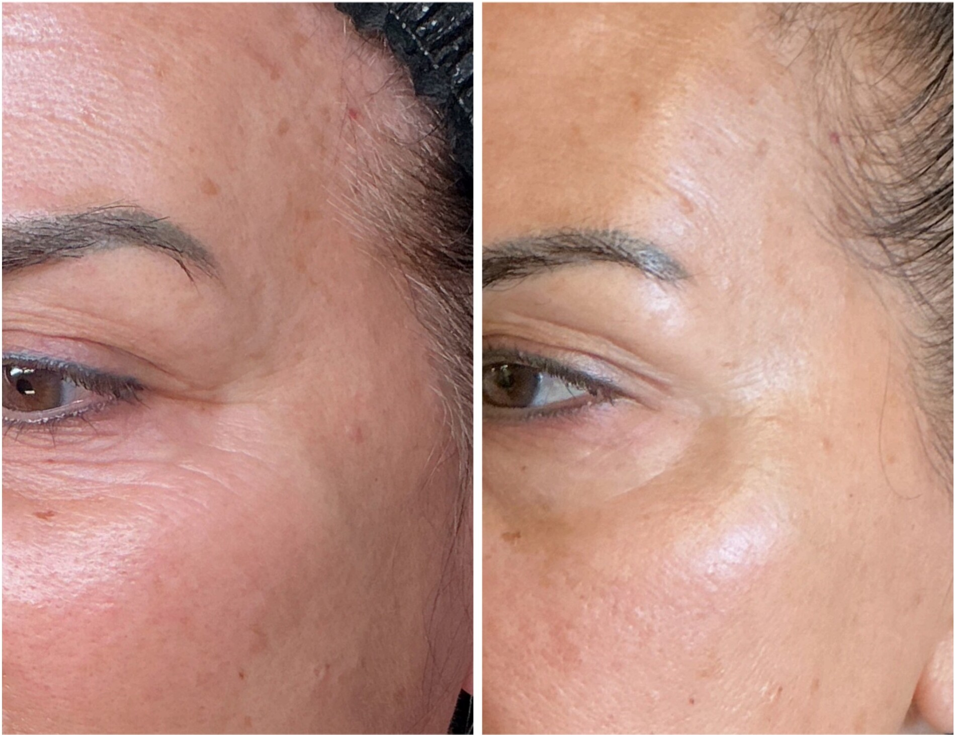 Before and after skin rejuvenation treatment